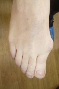 Ятрогенный Hallus valgus